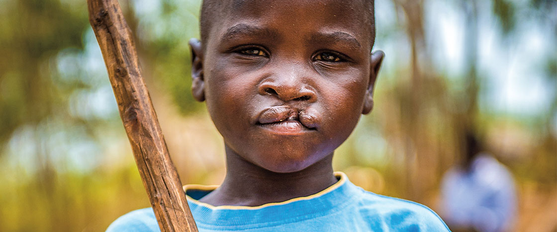 a boy with a cleft lip holding a stick